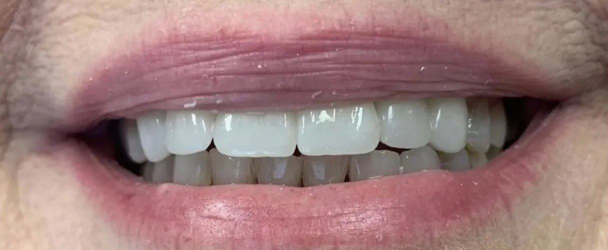 Smile after treatment: bright, even upper front teeth