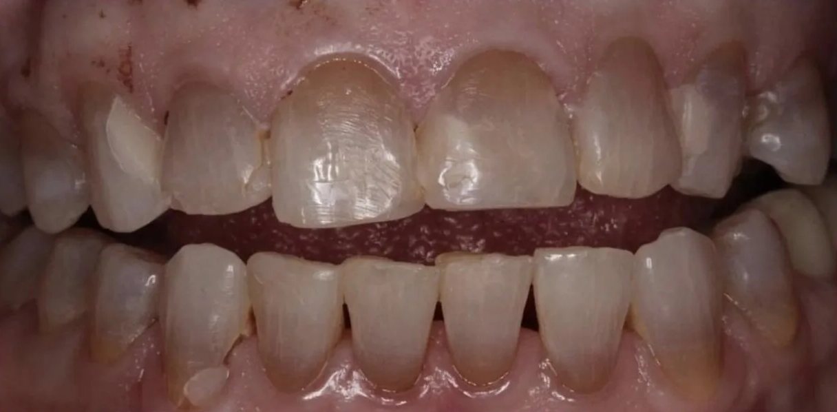 Retracted view before treatment: worn, chipped and discoloured upper and lower front teeth