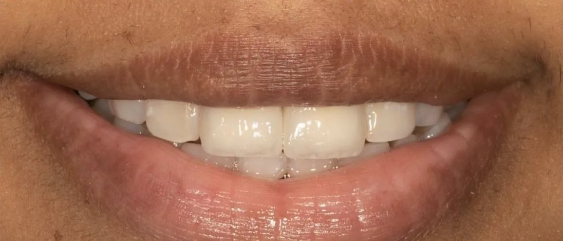 Smile after treatment: fuller, even upper front teeth with the gap closed