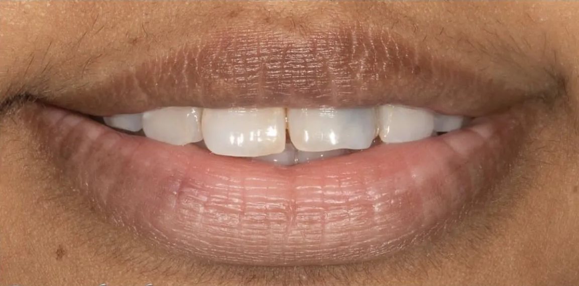 Smile before treatment: small, uneven upper front teeth with a gap between the centrals
