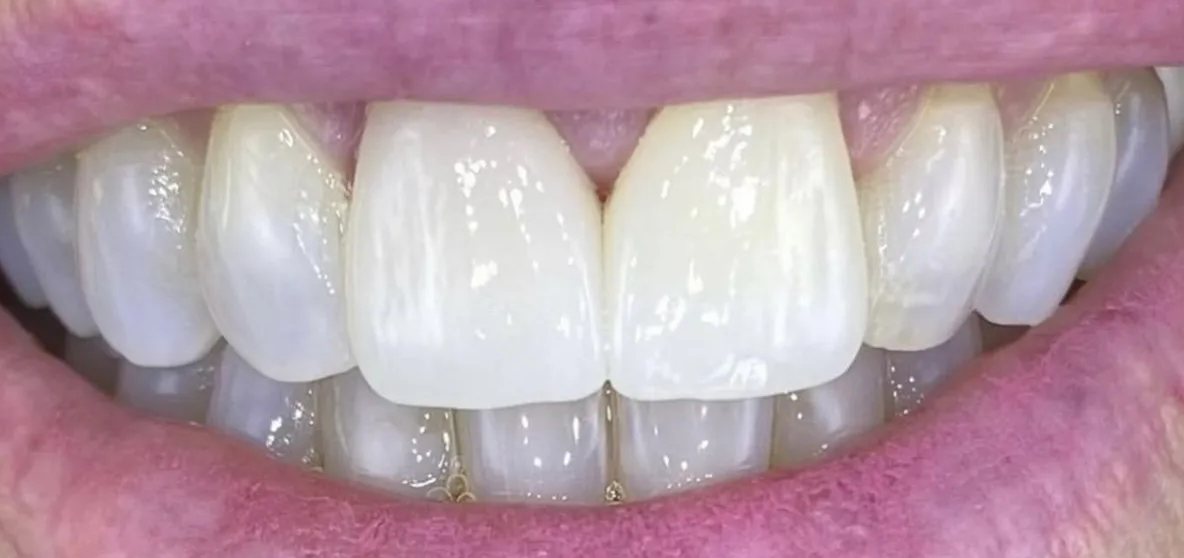 Smile after treatment: both upper central incisors bright and evenly matched