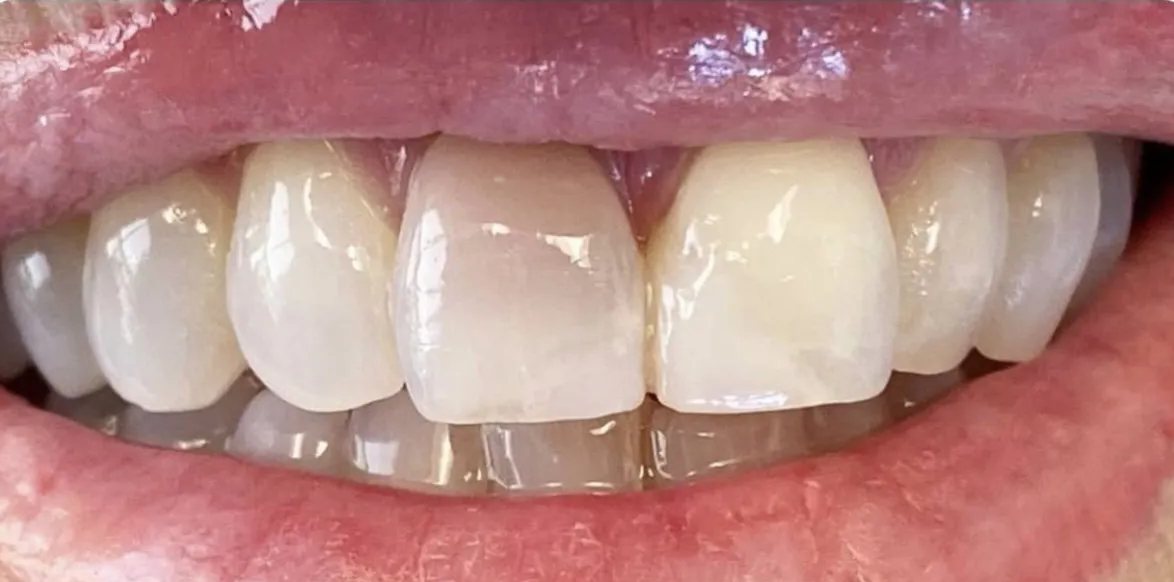 Smile before treatment: one upper central incisor darker than its neighbour