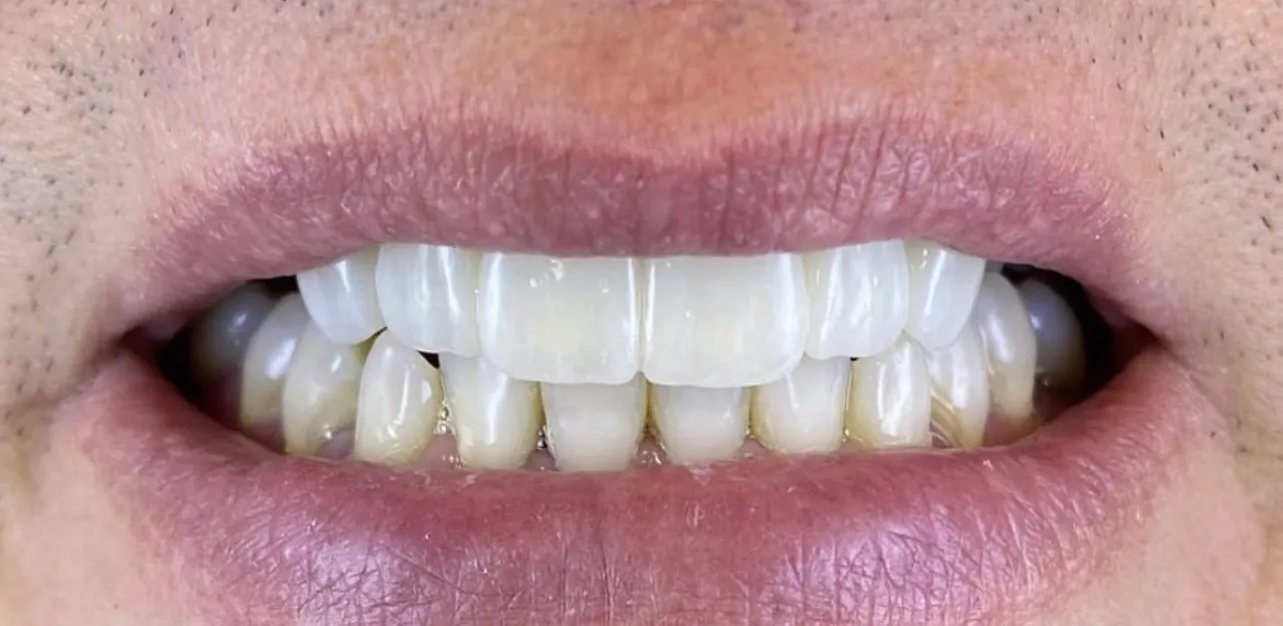 Smile after treatment: straight, even, bright upper front teeth