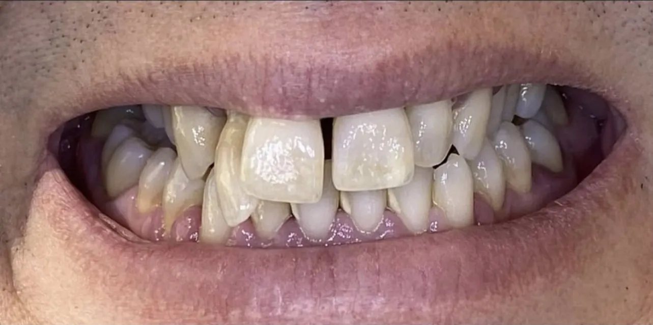 Smile before treatment: crowded, spaced and yellowed upper front teeth