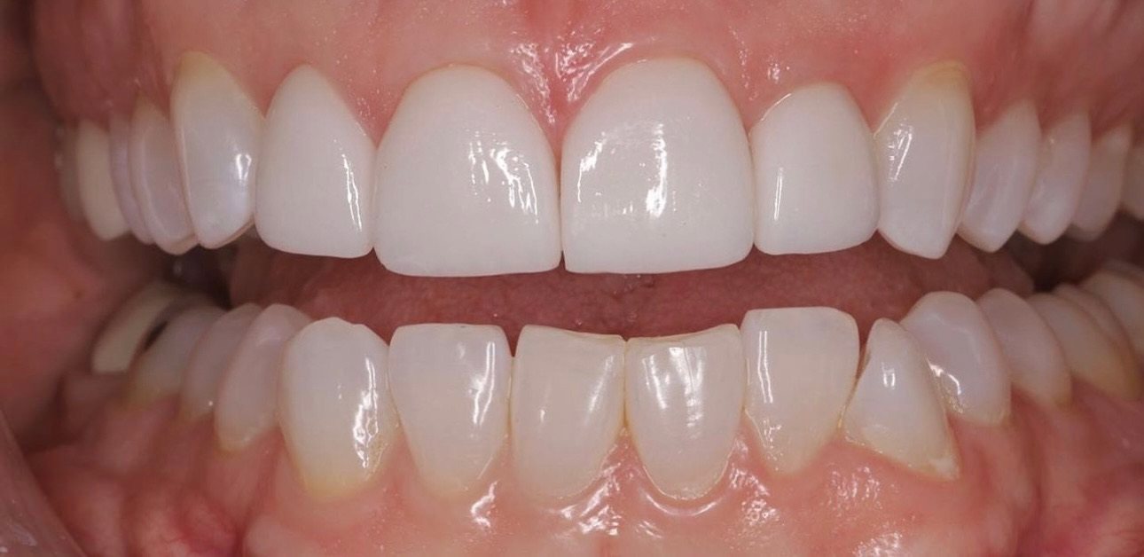 Retracted view after treatment, showing restored central incisors matched to the adjacent teeth