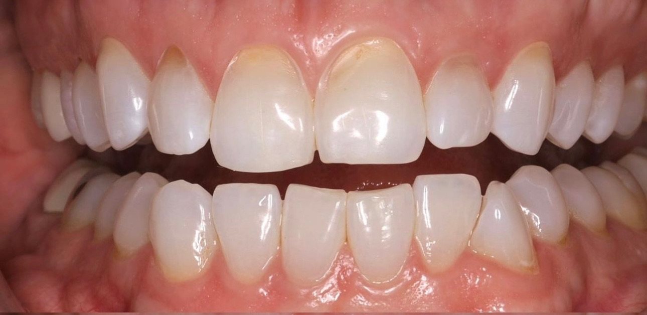 Retracted view before treatment, showing worn and stained incisal edges on the central incisors