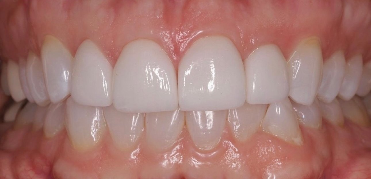 Retracted view in occlusion after treatment, the restored centrals even and matched to the adjacent teeth