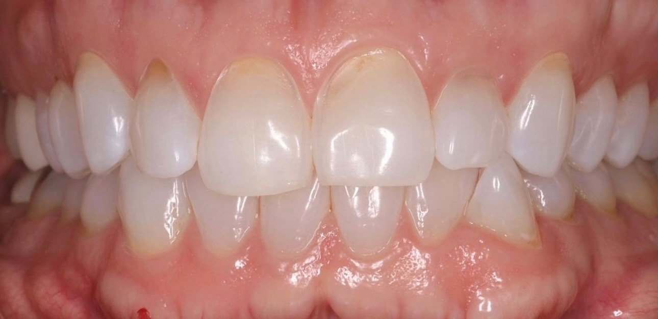 Retracted view in occlusion before treatment, the central incisors yellowed at the incisal third