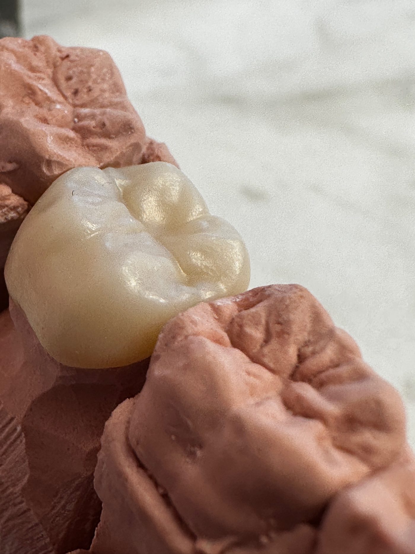 Posterior all-ceramic crown seated on a soft tissue working model, occlusal view