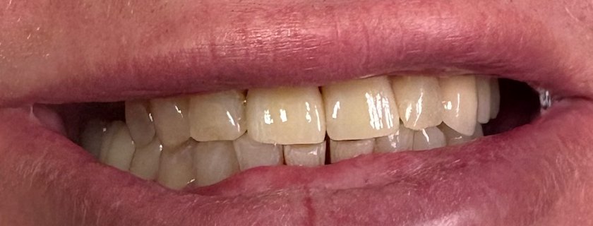 Restored upper anterior teeth photographed at the seating appointment