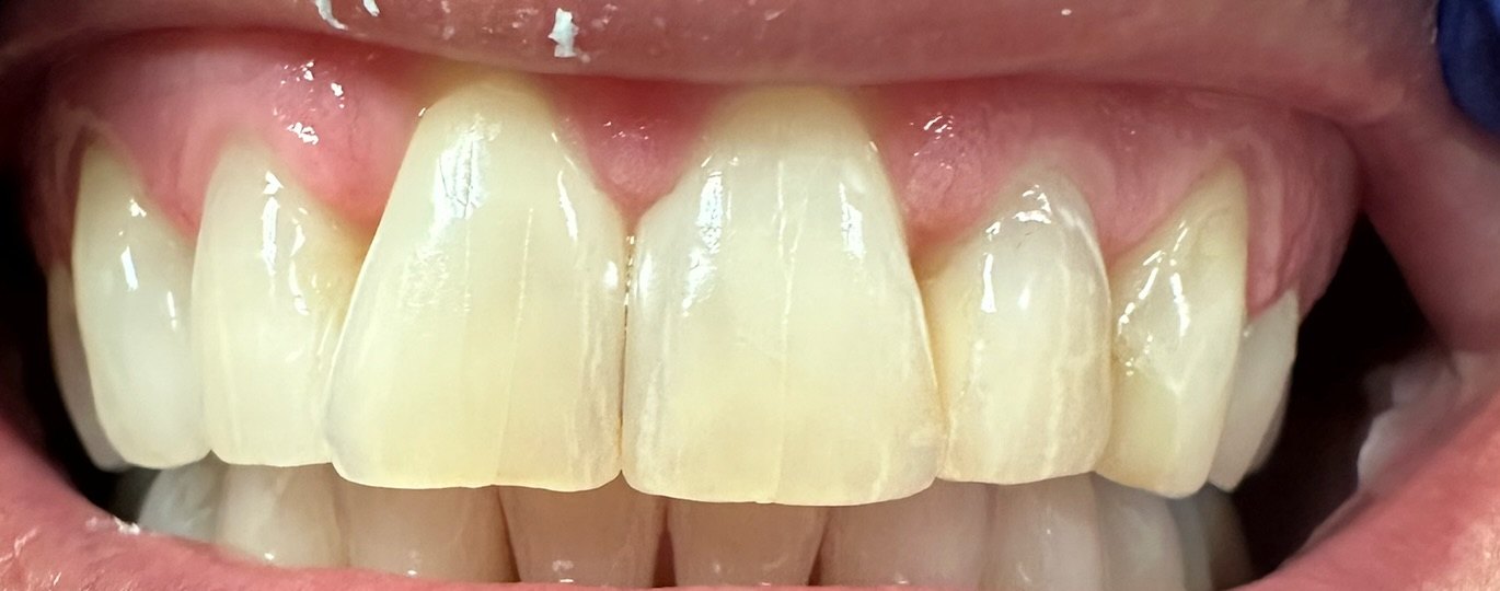 Close view of restored upper central and lateral incisors