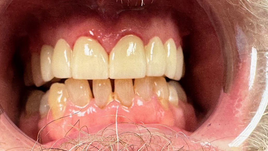 Full retracted view of restored upper anterior teeth against the natural lower arch