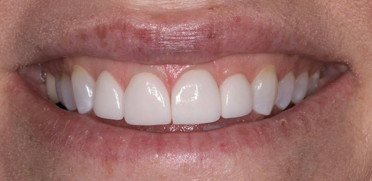 Smile view after treatment, the restored centrals even and matched to the arch