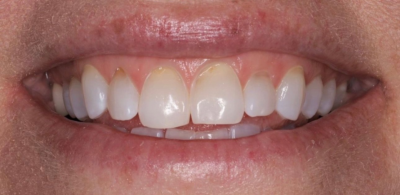 Smile view before treatment, the central incisors yellowed and worn at the incisal edges