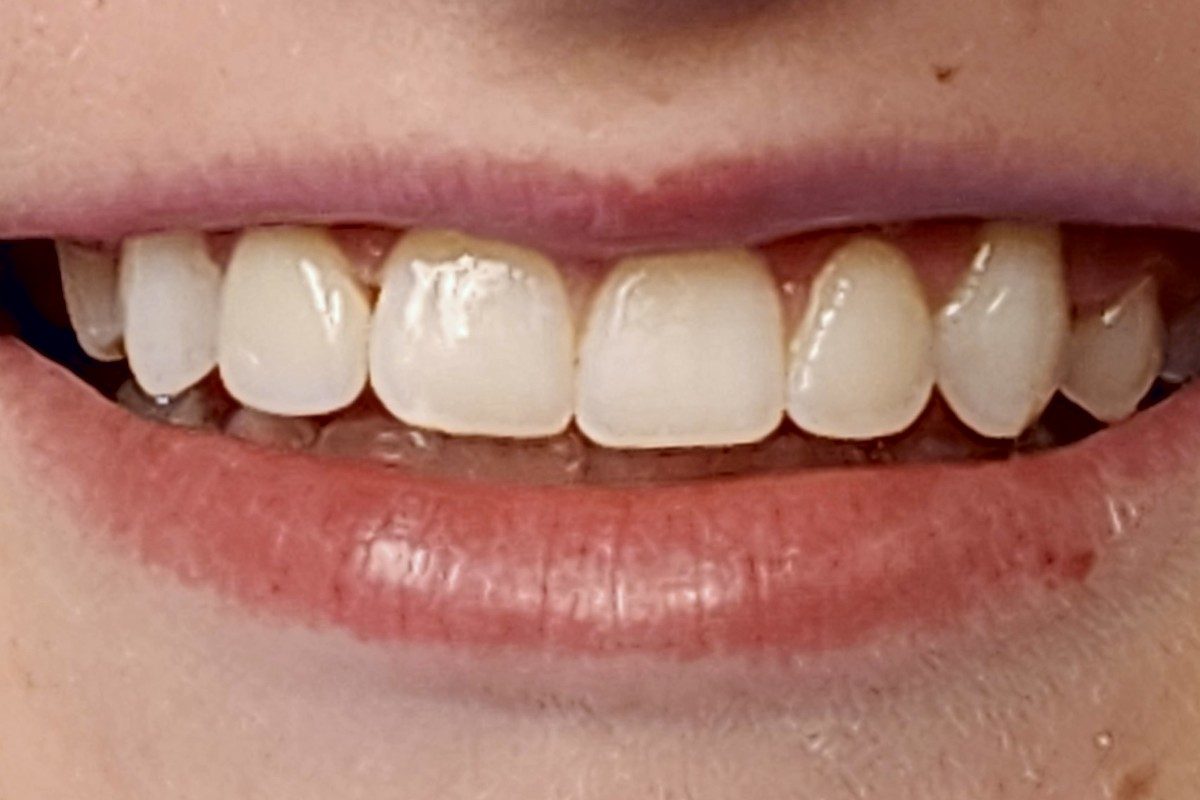 Smile showing even, natural-looking upper front teeth