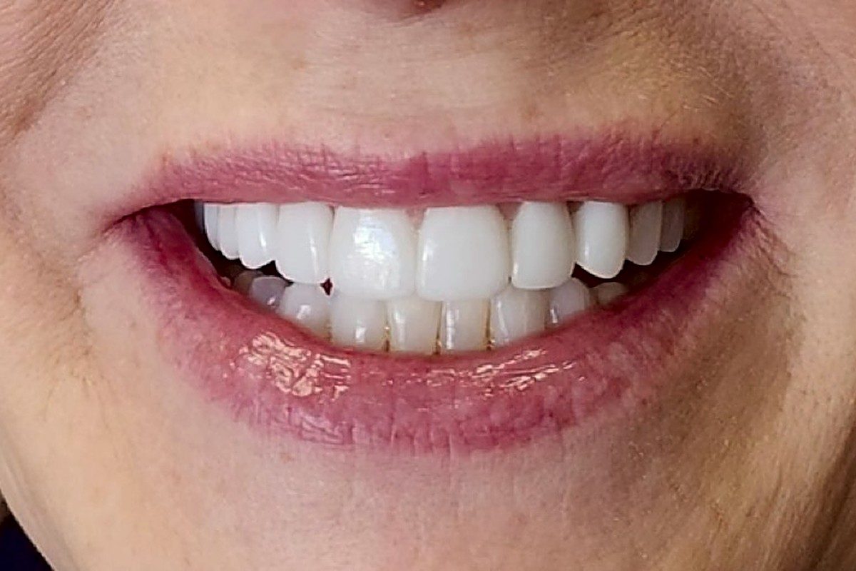 Wide smile with bright white upper teeth