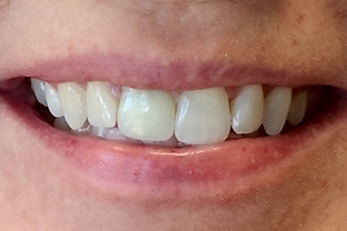 Relaxed smile showing the upper front teeth
