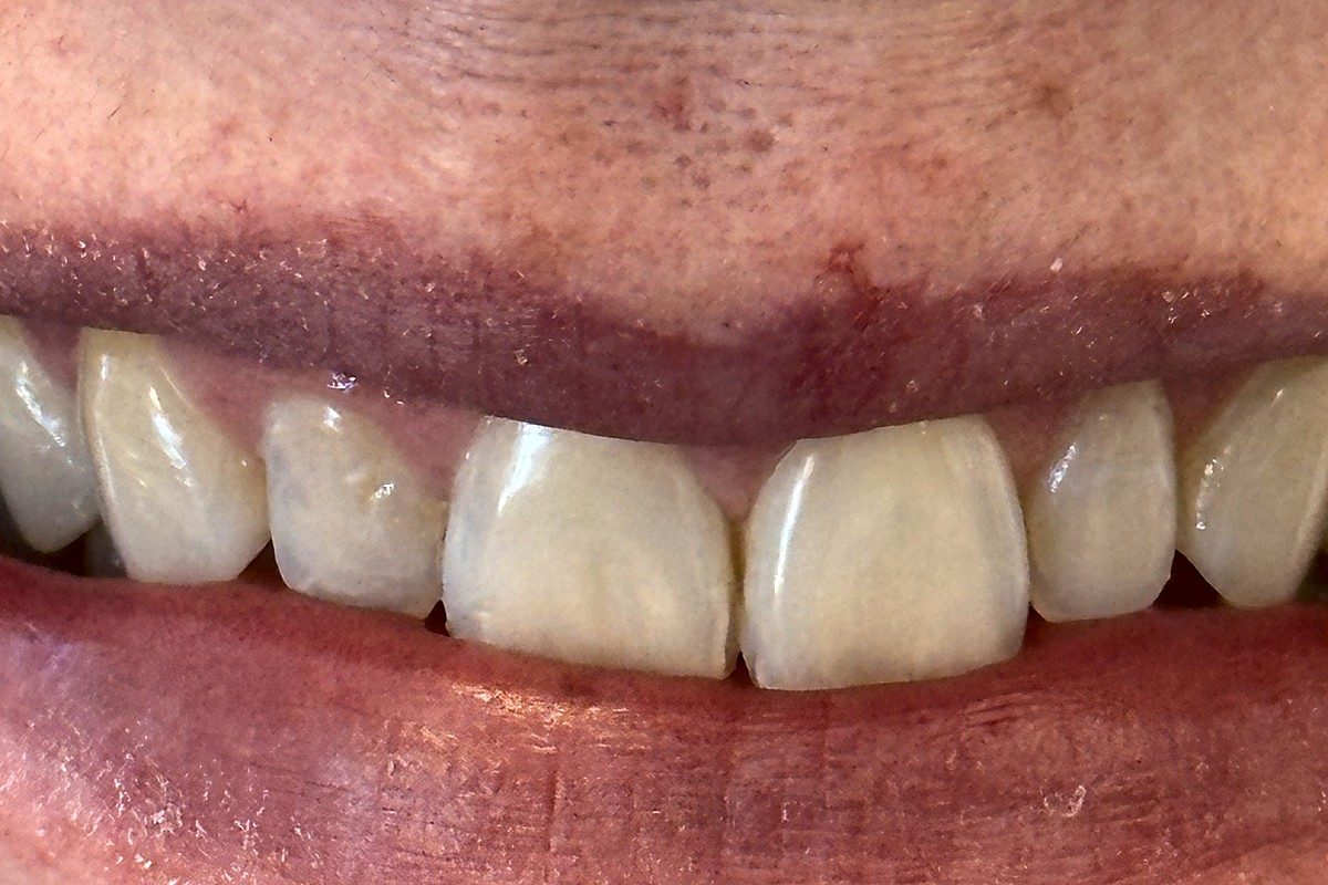 Close smile view of the upper front teeth