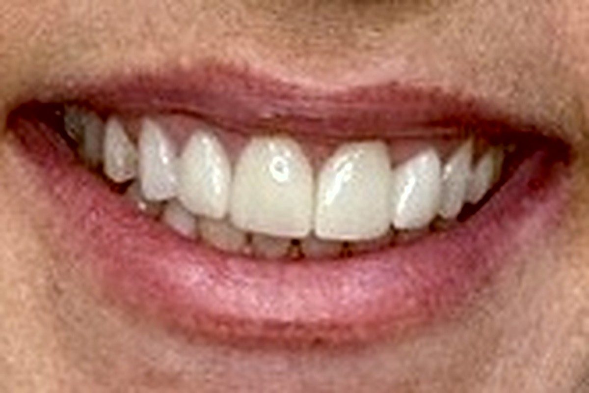 Smile with bright, even upper front teeth