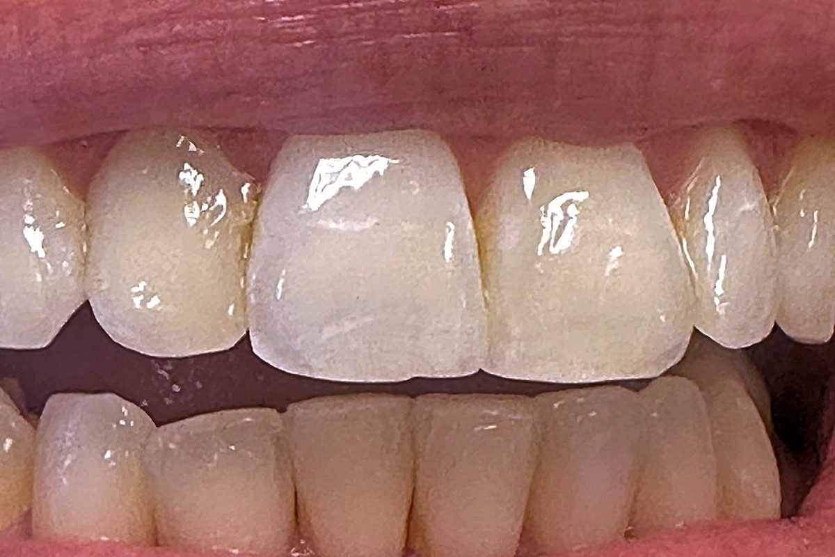 Close view of the upper central incisors over the lower teeth