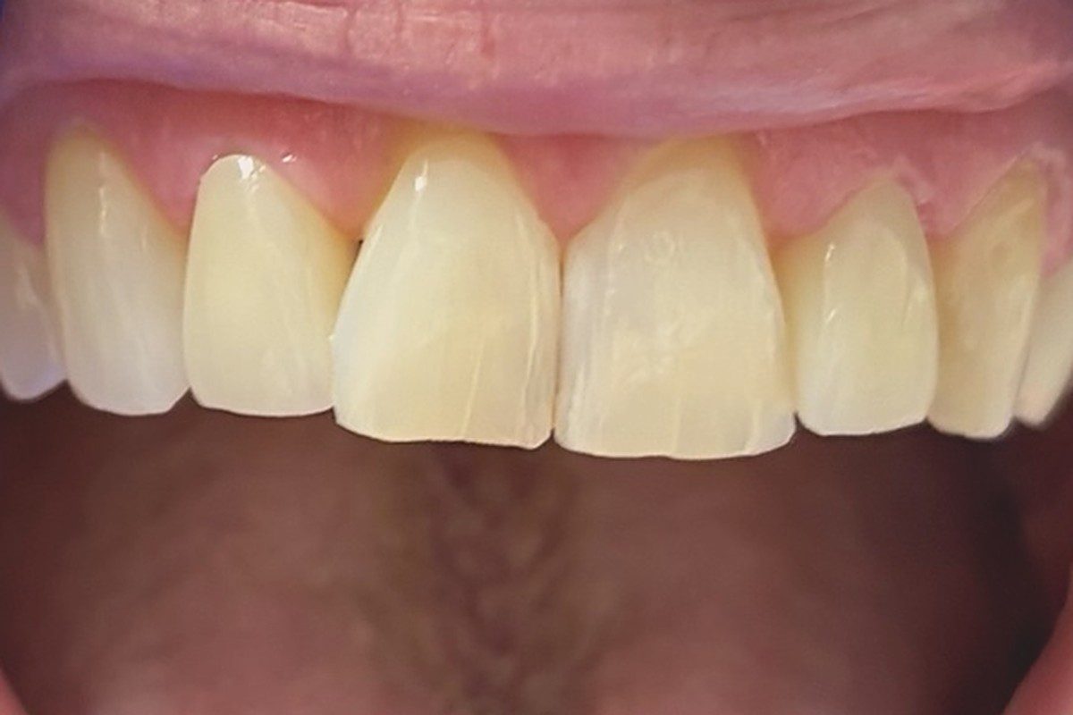 Upper front teeth photographed with the mouth open