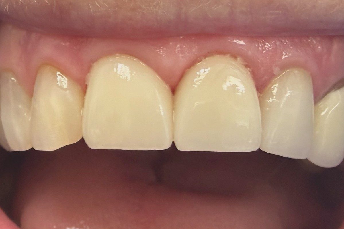 Upper central incisors and neighbouring teeth, mouth open