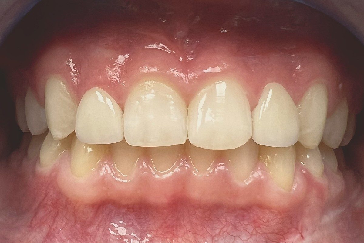 Retracted view of the upper and lower front teeth together