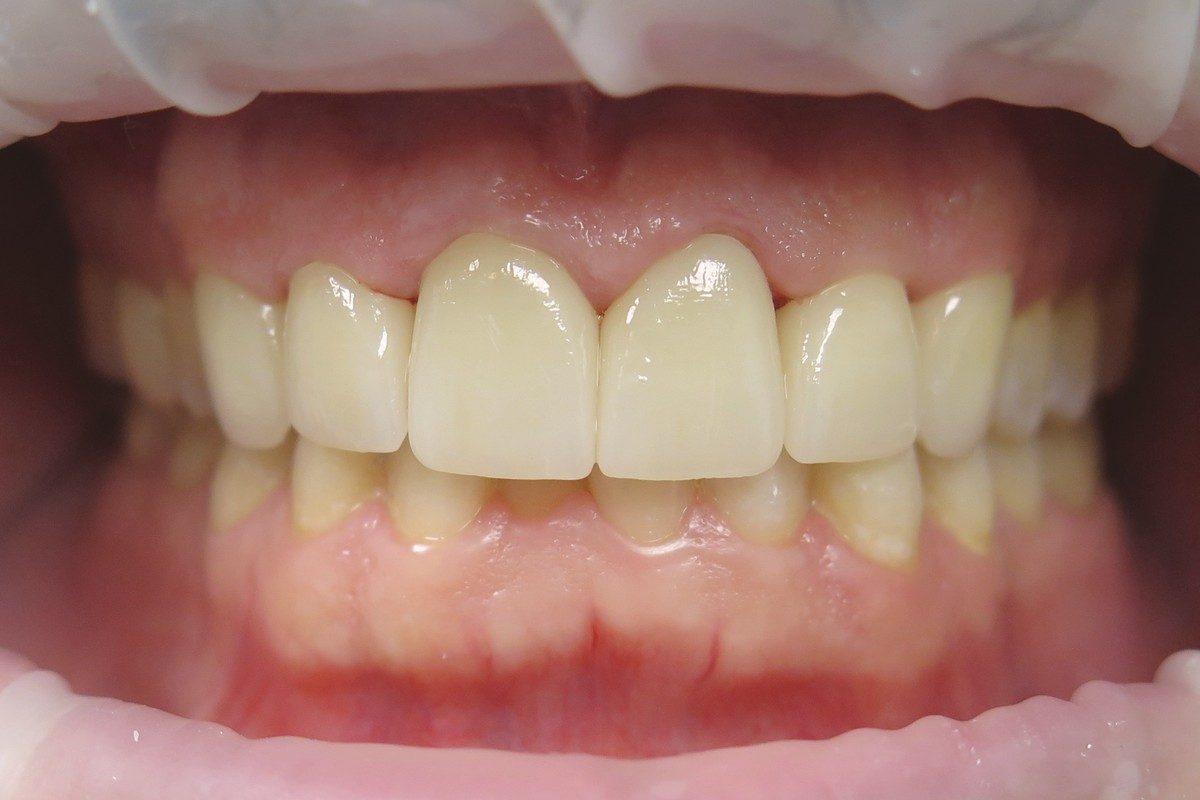 Retracted view of the upper front teeth