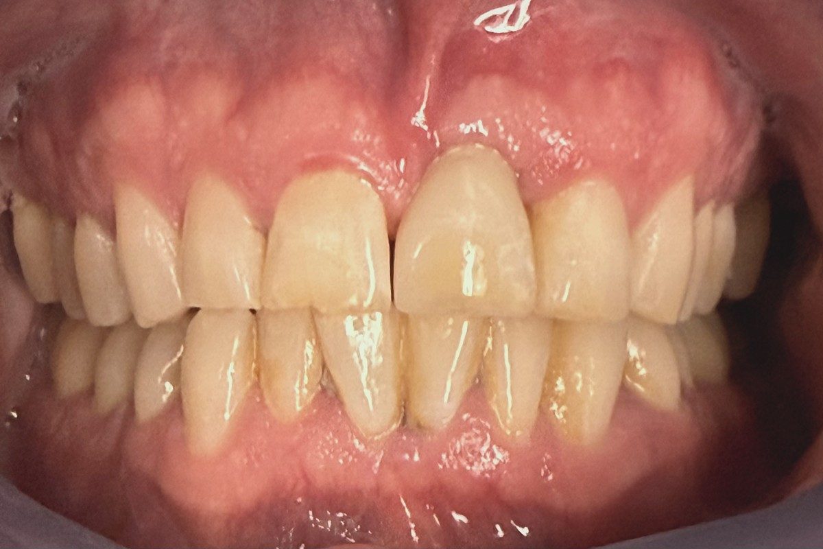 Retracted view of the upper and lower front teeth