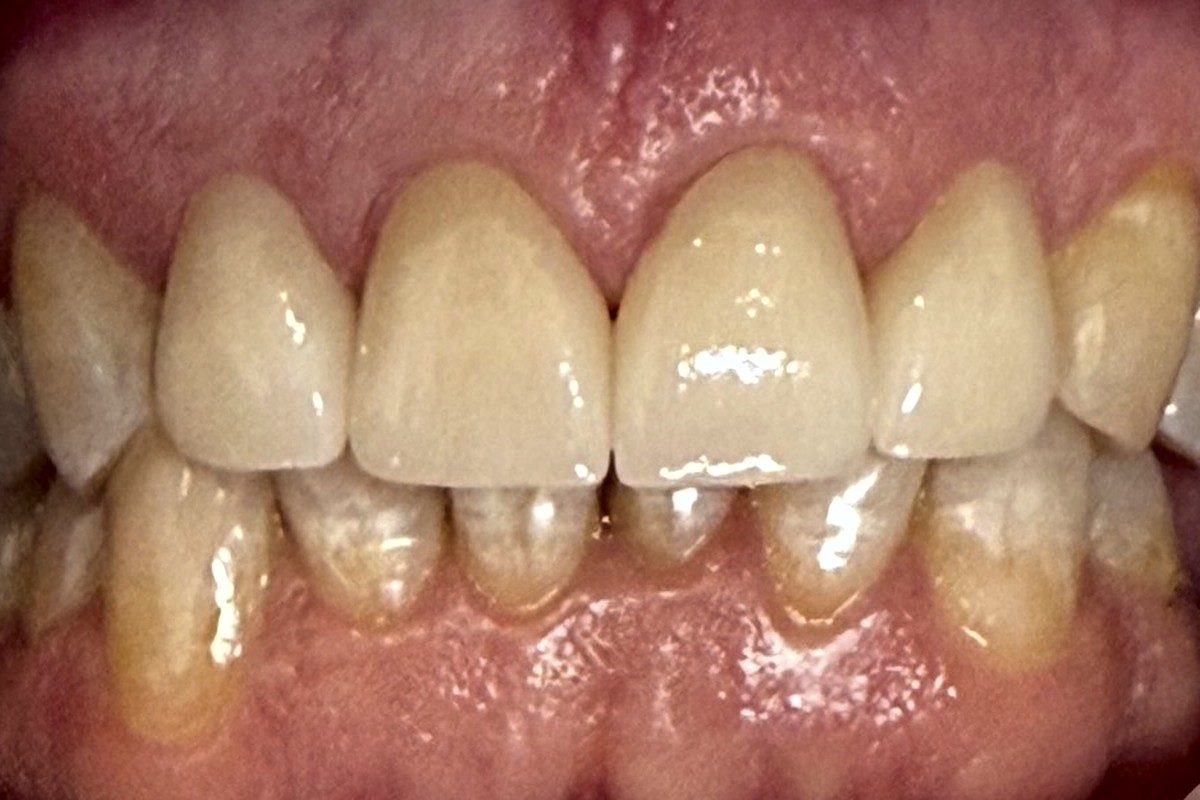 Retracted view of the upper front teeth over the lower arch