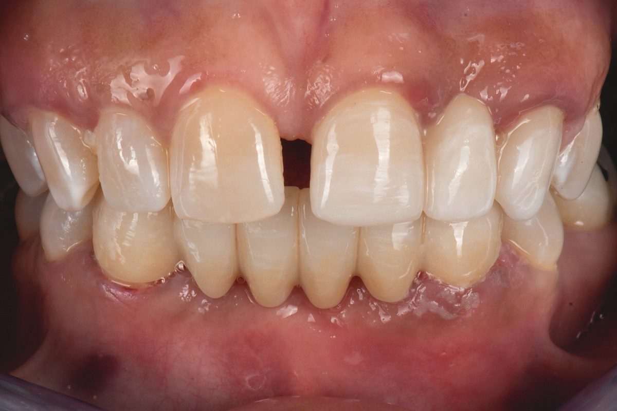 Retracted view of the upper front teeth with a space between the central incisors