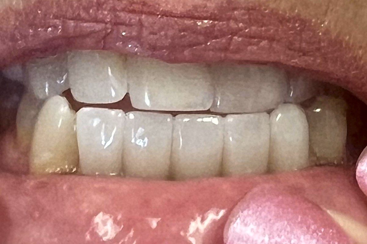 Front teeth together, the lip held aside