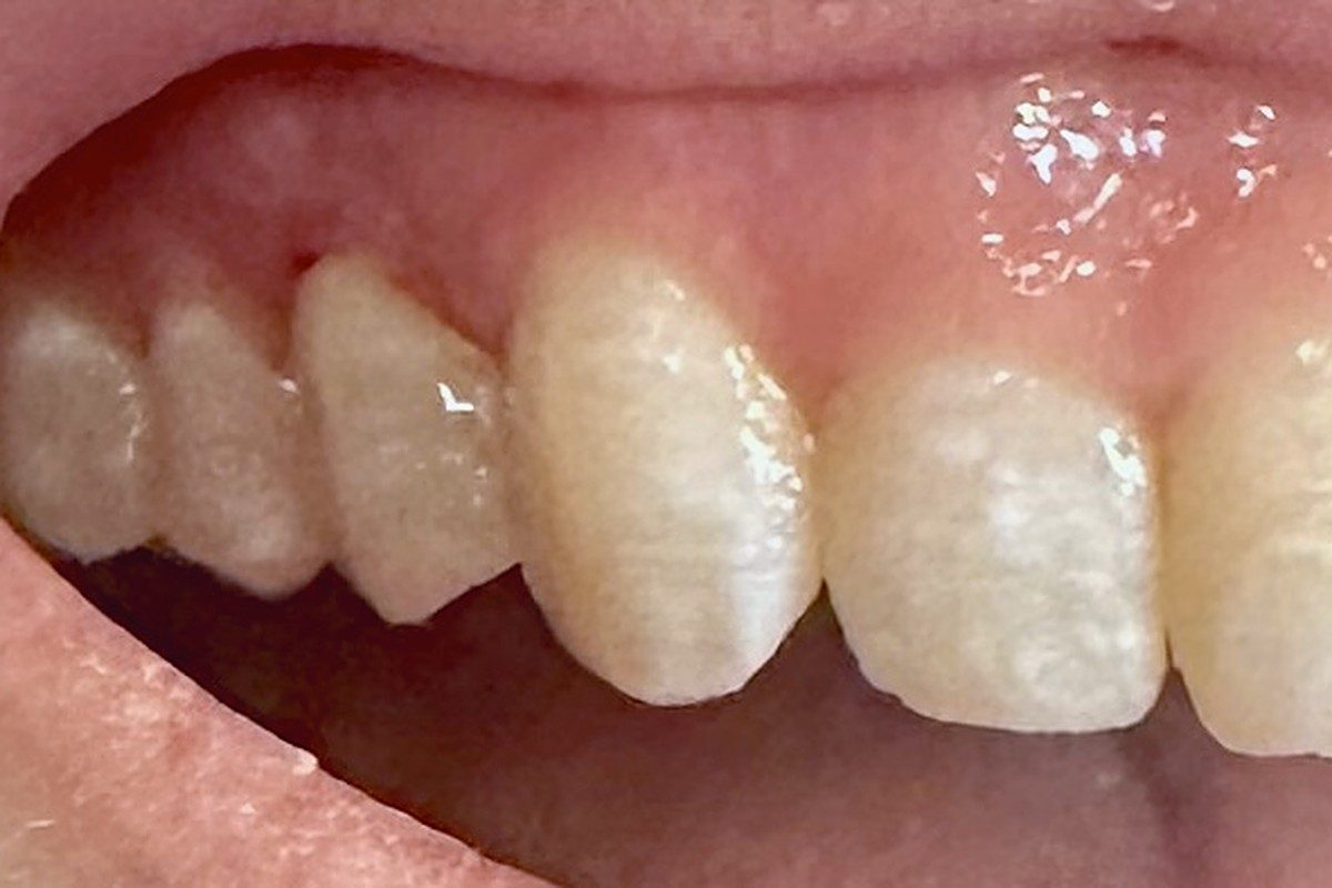 Side view of the upper teeth from the canine back