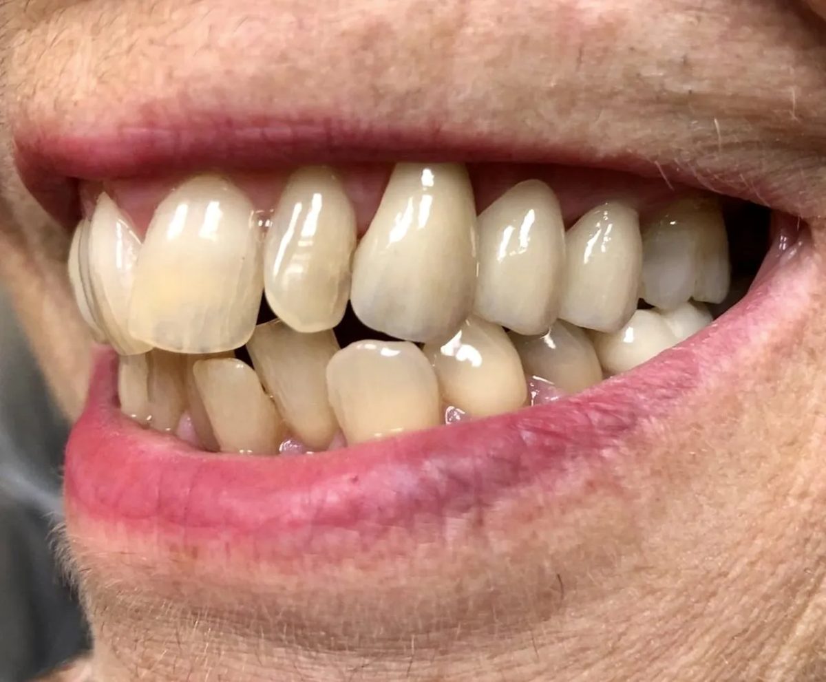 Side view of a smile, upper and lower teeth