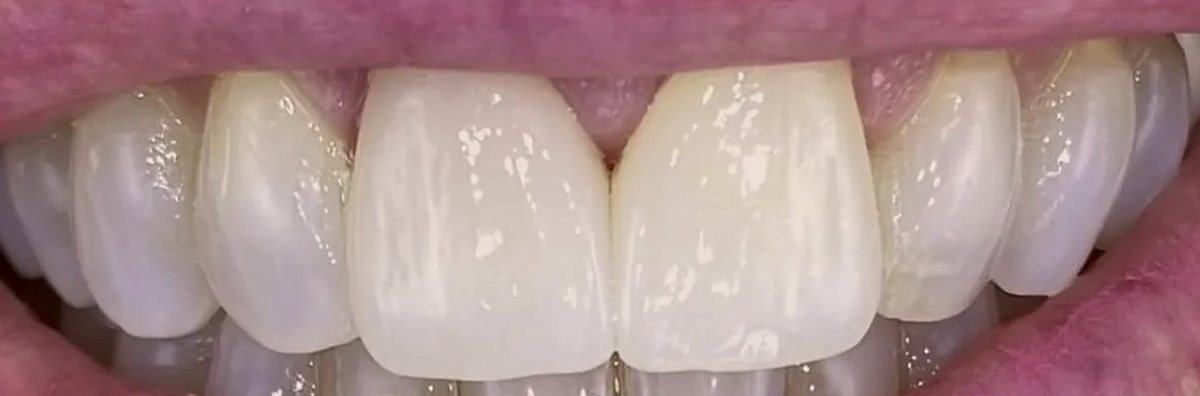 Smile after treatment, both upper central incisors bright and evenly matched
