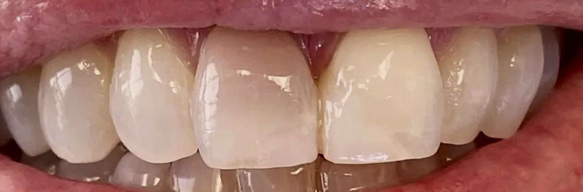 Smile before treatment, one upper central incisor darker than the other