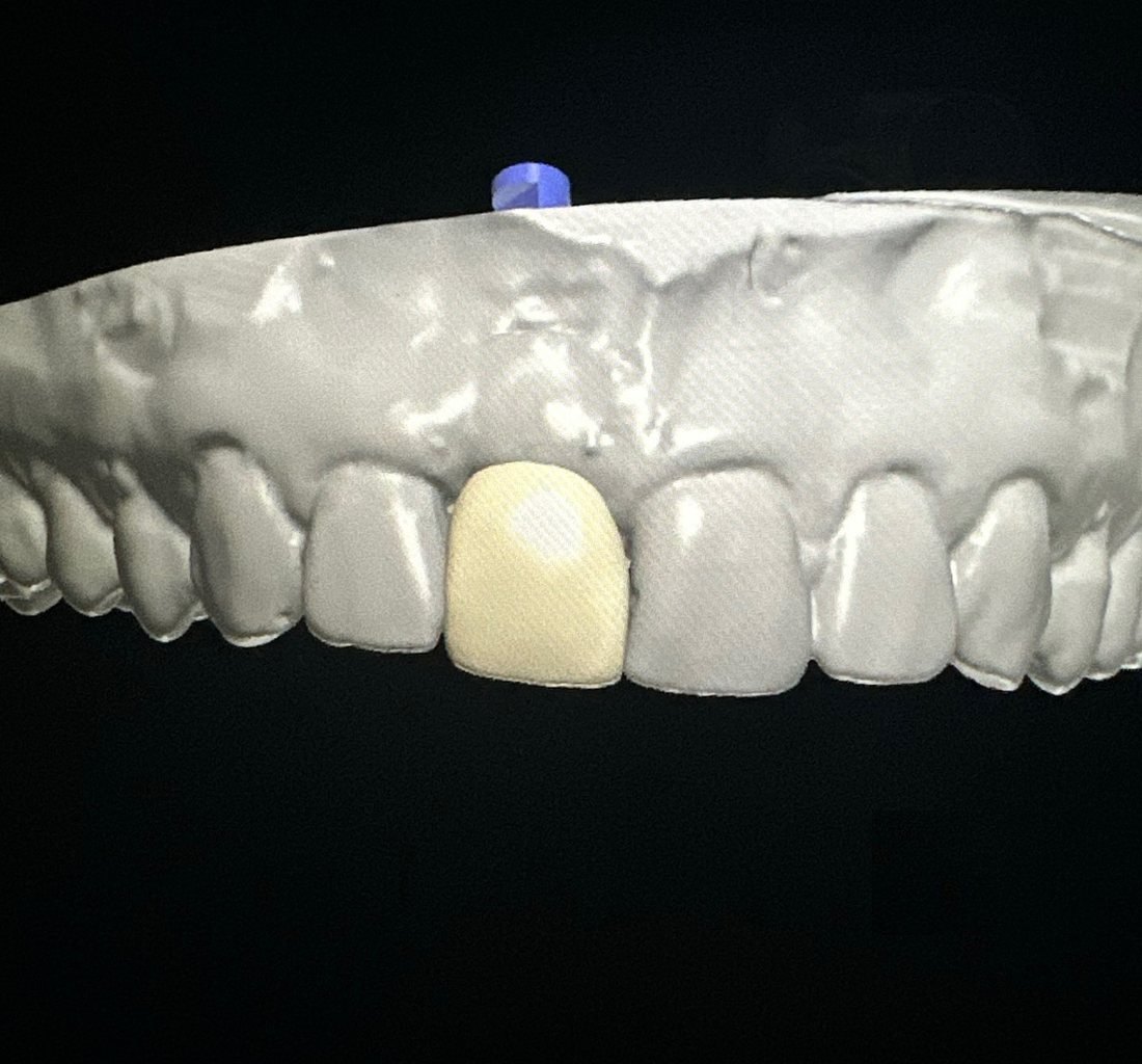 A single anterior crown designed in CAD software over the patient's scanned arch