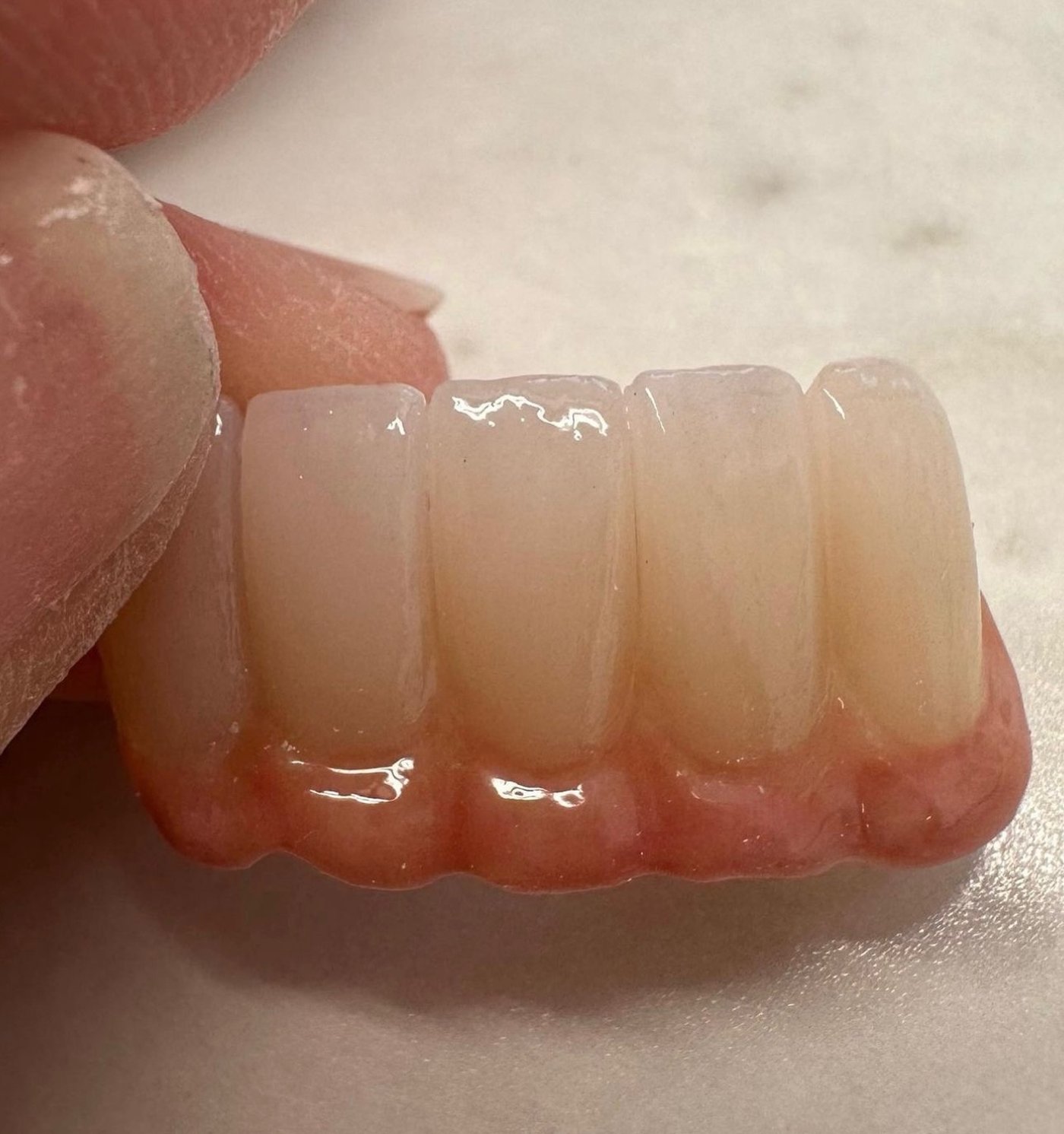 An anterior segment with gingival porcelain, the pink tissue shade layered against the tooth shade