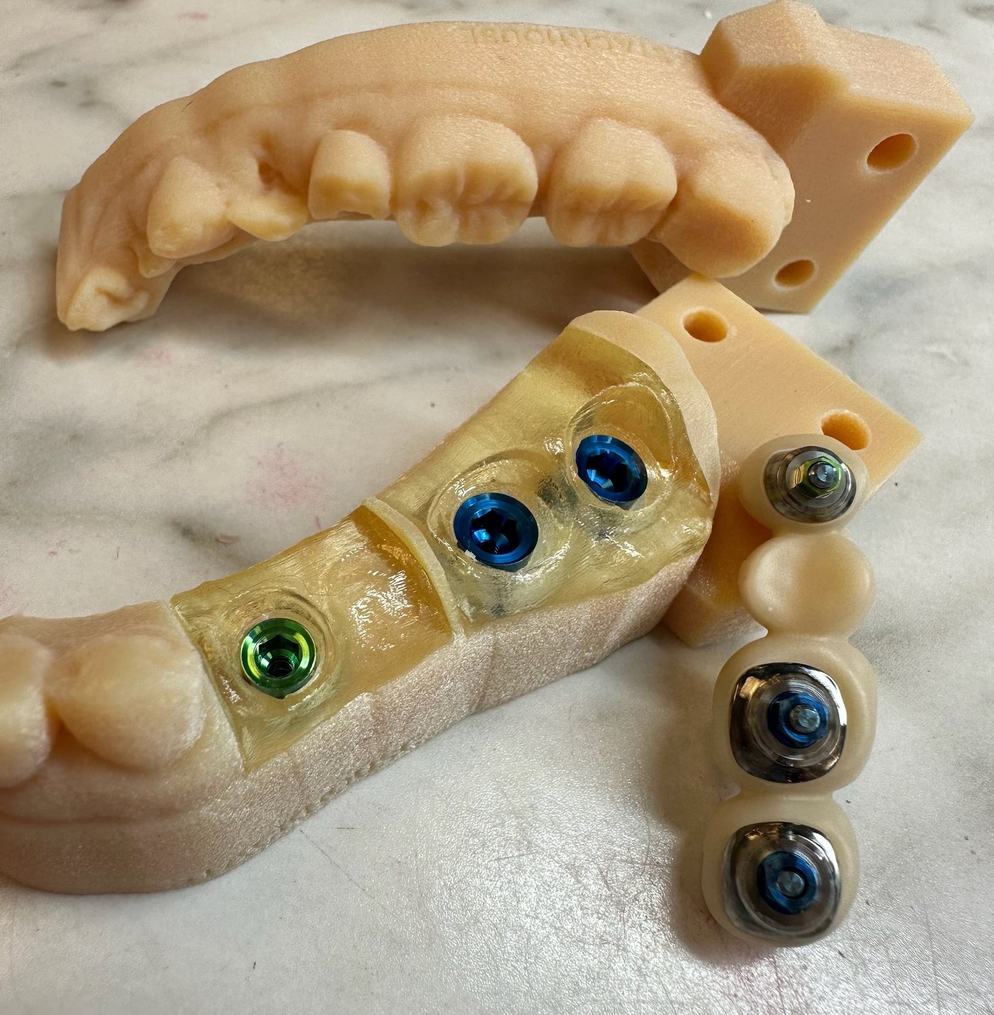 An implant case on the printed model: multi-unit abutments with coloured screws and a screw-retained restoration