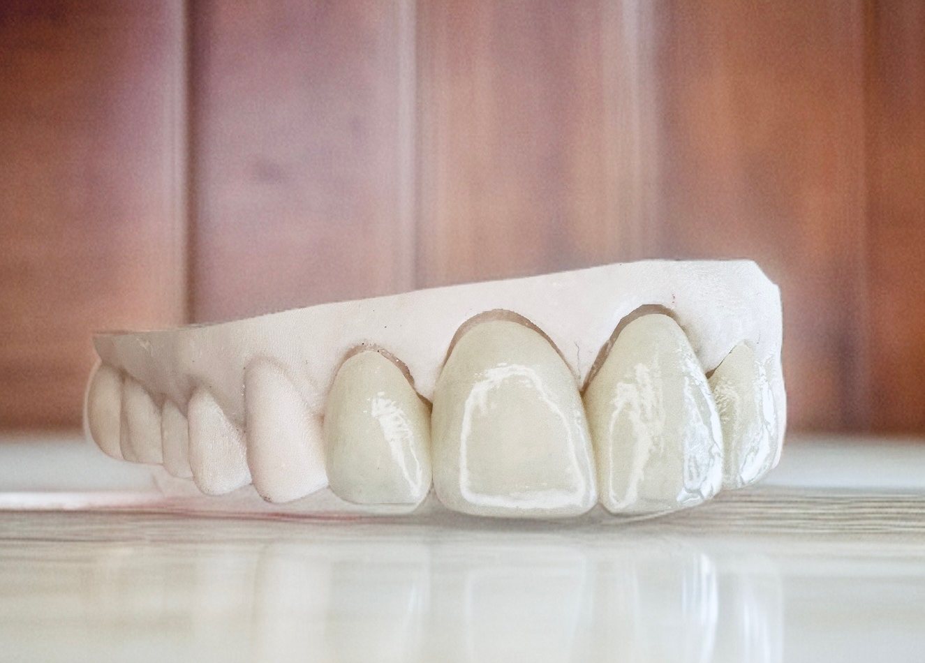 Anterior all-ceramic restoration on a working model, photographed from the side to show incisal translucency